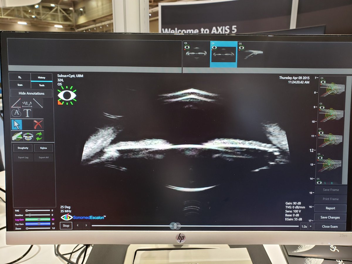 OPHTHALMOLOGIST's tweet photo. Visit Team #Sonomed Escalon at American Academy of Ophthalmology #AAO2021 in NOLA # 655
visit www https://t.co/aIbedRMNOO
Follow:
@SonomedEscalon
#ophthalmicultrasound #cataract #vupad #vumax #ophthalmology #eyecare #govu #ultrasound #vision #ophthalmic #ophthalmicequipment https://t.co/nSlIixPJdS