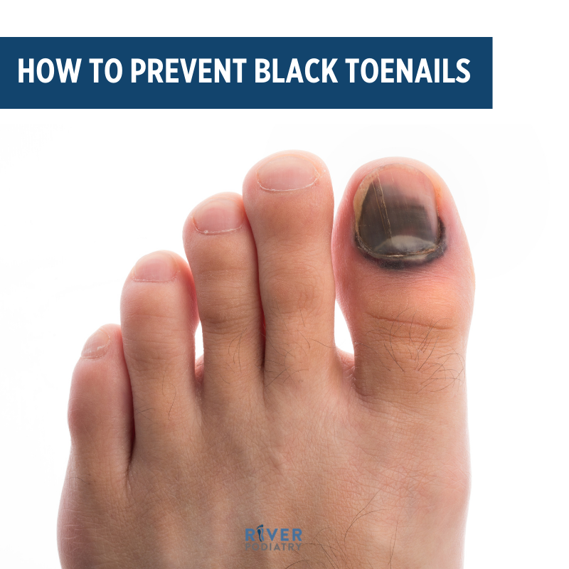 River_Podiatry's tweet photo. Typically, black toenails are not something that you need to worry about as they are usually caused by bruising or bleeding underneath the toenail. Click the link below to learn more.

https://t.co/oAPgy08RCP https://t.co/VKLsNnI3GE