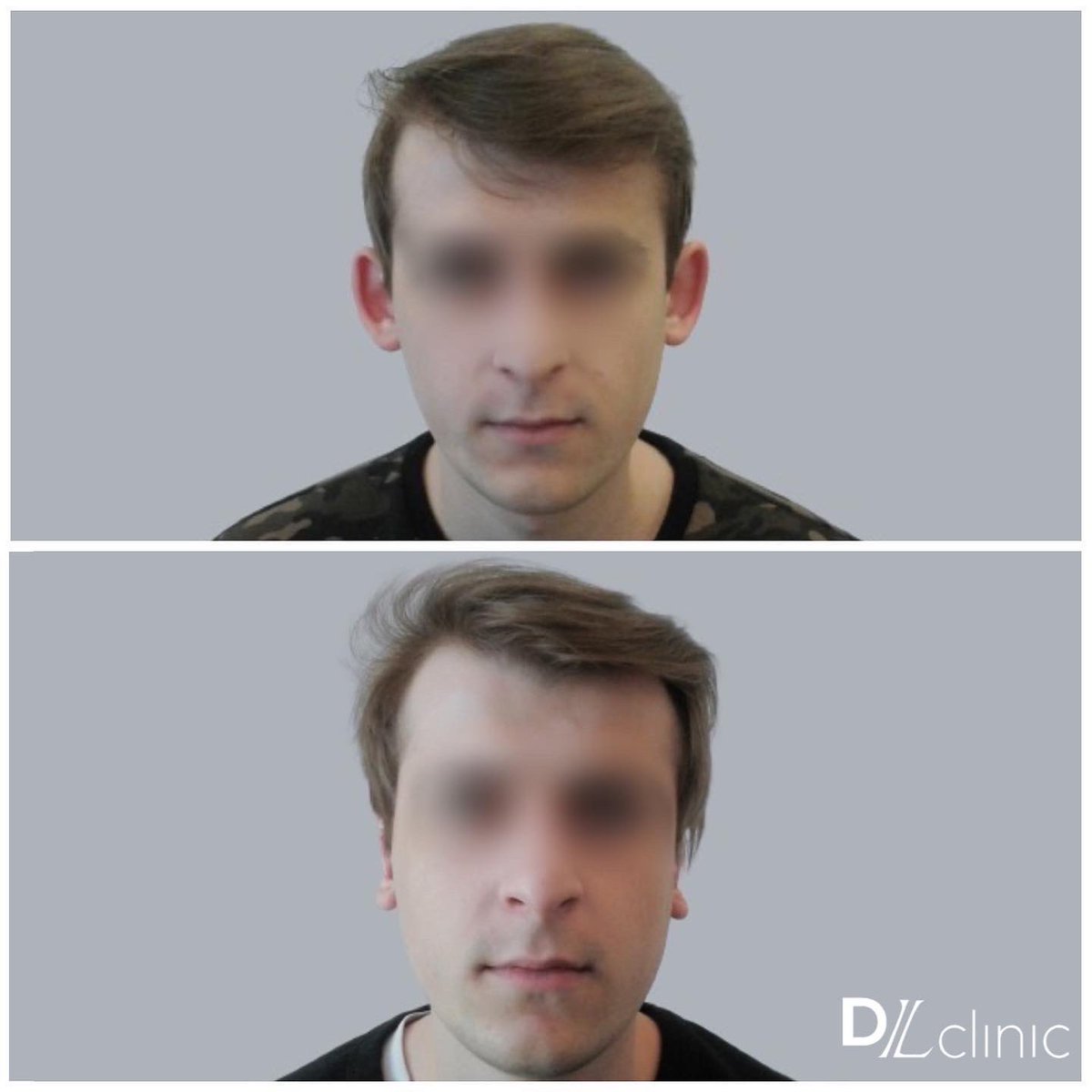 Лопоухость – особенность, которая никак не влияет на качество слуха, но при этом может существенно понизить качество жизни. 

#отопластика позволяет сделать уши эстетически привлекательными и избавиться от множества комплексов! 
instagram.com/p/CWNzMGbgr0r/… #пластическийхирургспб