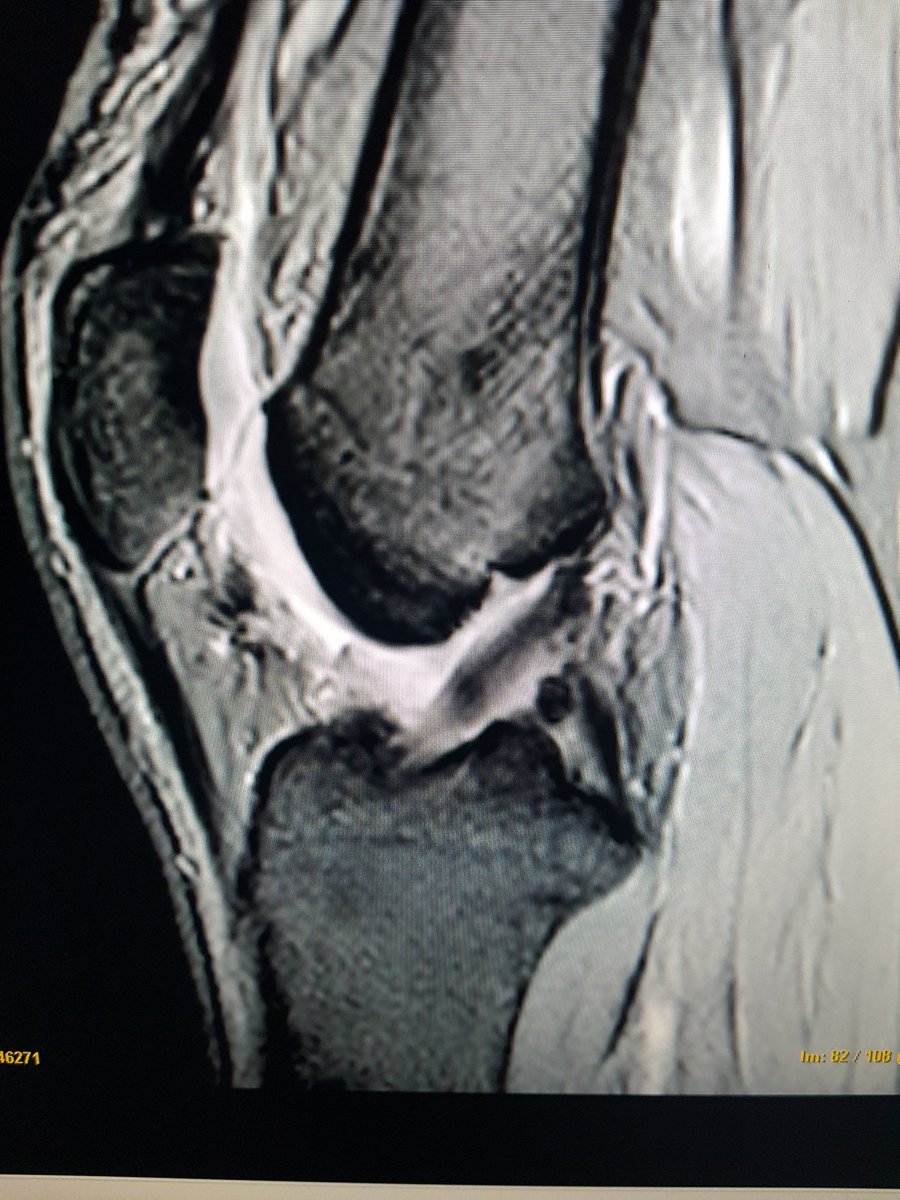 AlbertoLopezAr1's tweet photo. Imagen de Rmn de RLCA con injerto de cuadricipital de 8 meses de evolucion:
-Se observa señal de la plastia similar al LCP lo que puede indicar avanzada fase de ligamentizacion.

@DrMontesGonzle1 #RLCA #trauma #knee https://t.co/67pIrtFMCN
