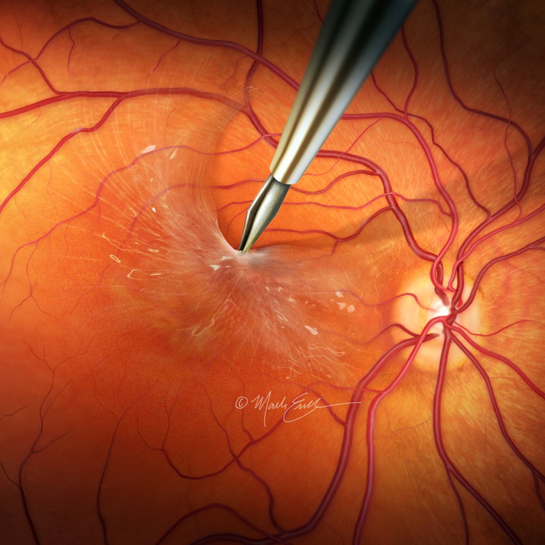 MedicalArtist's tweet photo. Epiretinal membrane peel art created with a Wacom painting tablet. 
#AAO2021 #AAO21 https://t.co/Yry7zdYq73