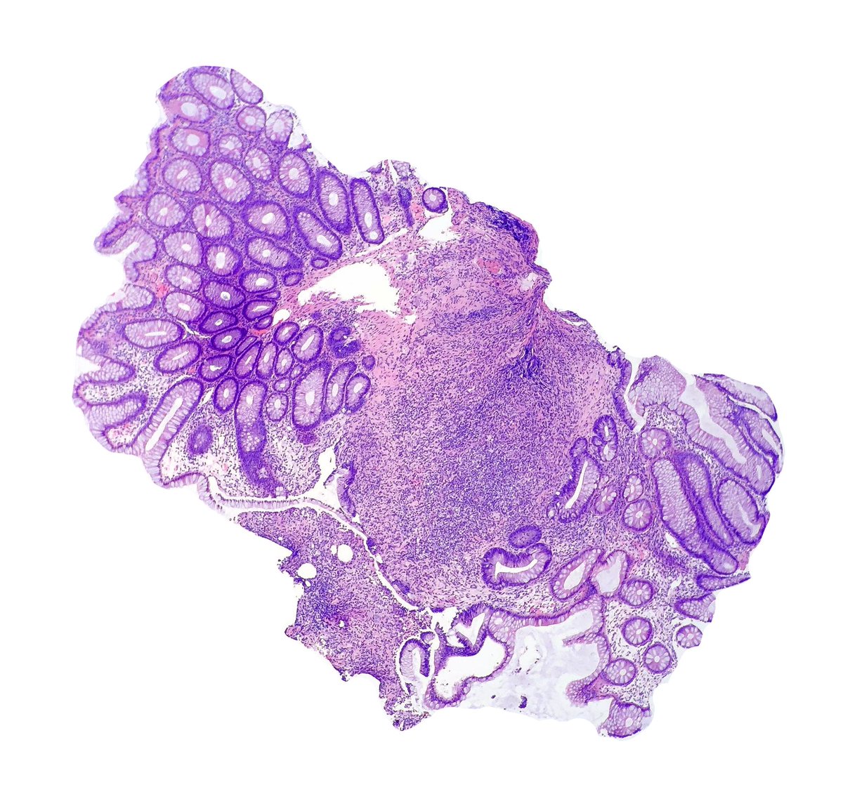 DCSkipperDO's tweet photo. It’s nice to know you made a difference in the care of a patient. 80-year-old woman hx of SMA stenosis with severe abd pain and diarrhea. Ischemia suspected. Patient continued to deteriorate during hospitalization so bx done #pathology #surgpath #gipath #whypathologistsmatter https://t.co/Ww7jQscNFf