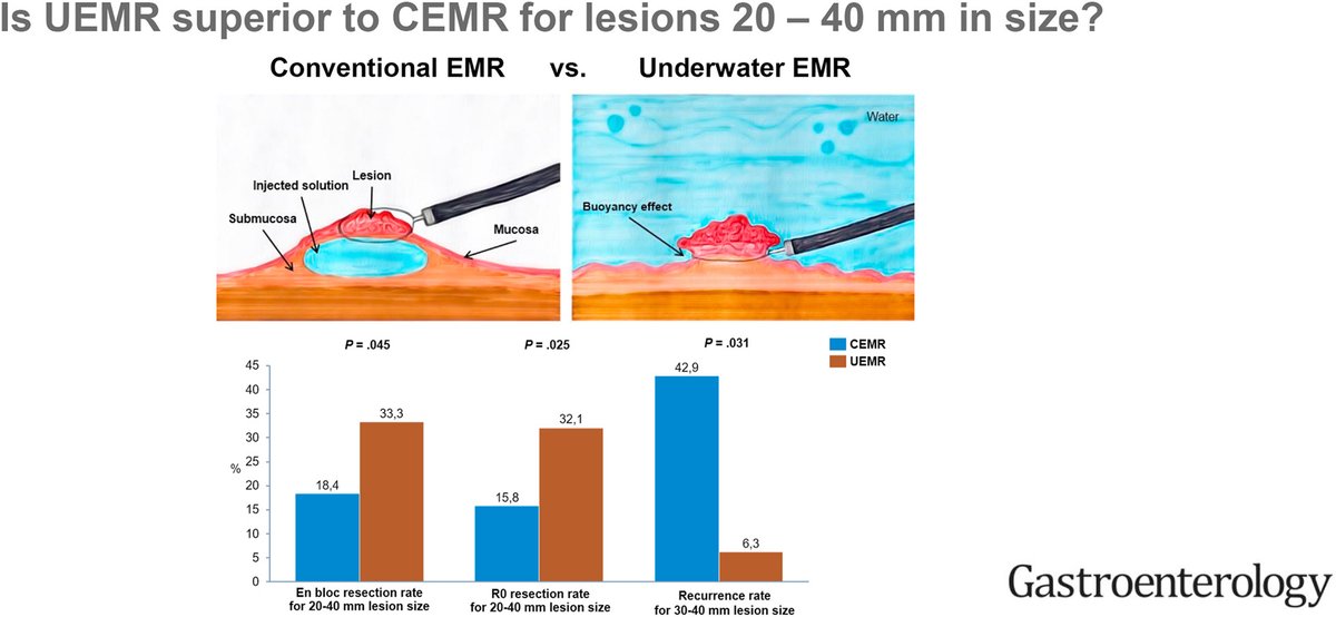 Douglas Corley (@douglascorley) on Twitter photo Is underwater endoscopy really a better way to take off large polyps?
A new randomized trial provides some answers.
gastrojournal.org/article/S0016-…
<a href="/UmaMahadevanIBD/">Uma Mahadevan</a> <a href="/IBDMD/">David T. Rubin, MD</a> <a href="/RickPeekMD/">Rick Peek</a> <a href="/AGA_Gastro/">Gastroenterology</a> Is underwater endoscopy really a better way to take off large polyps?
A new randomized trial provides some answers.
gastrojournal.org/article/S0016-…
<a href="/UmaMahadevanIBD/">Uma Mahadevan</a> <a href="/IBDMD/">David T. Rubin, MD</a> <a href="/RickPeekMD/">Rick Peek</a> <a href="/AGA_Gastro/">Gastroenterology</a>