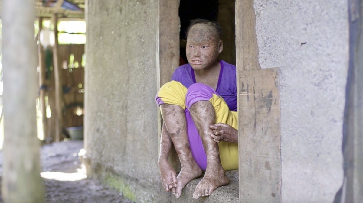 KM_Jessica_Soho's tweet photo. 14-anyos sa Lanao del Norte, nagbibitak at natutuklap ang balat mula ulo hanggang paa! Nakararanas pa ng panghuhusga sa ilang mga kapitbahay! #KMJS https://t.co/8nIHtFvJx6