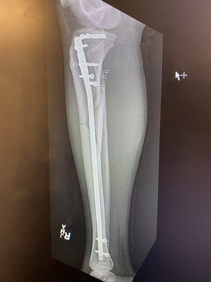 harrisslone's tweet photo. I've never regretted putting in blocking screws, but certainly have regretted not using them. Wanted to fall into varus and procurvatum w intact fibula. If you think about it- you probably should do it. Also had to use humeral reamers d/t stenotic canal #orthotwitter #traumacall https://t.co/g3ISEqSGEm