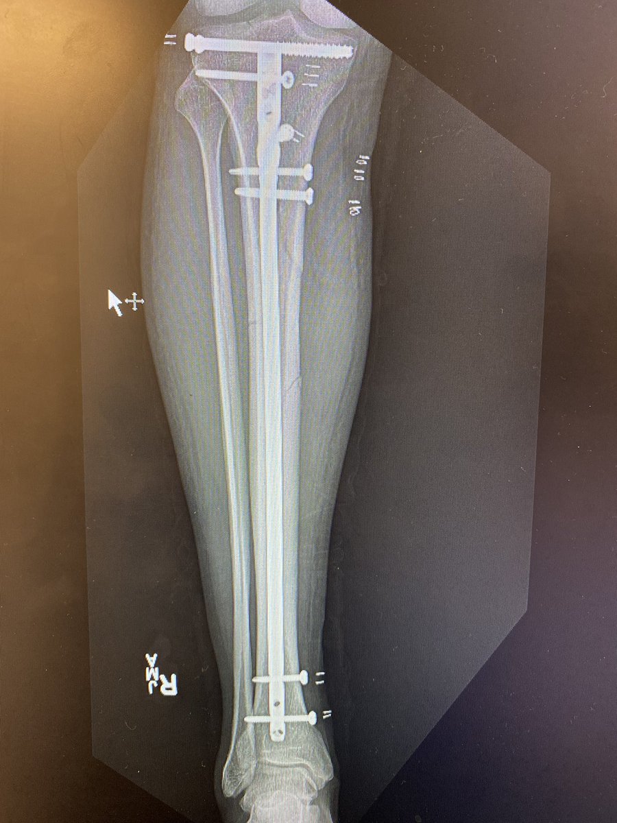 harrisslone's tweet photo. I've never regretted putting in blocking screws, but certainly have regretted not using them. Wanted to fall into varus and procurvatum w intact fibula. If you think about it- you probably should do it. Also had to use humeral reamers d/t stenotic canal #orthotwitter #traumacall https://t.co/g3ISEqSGEm