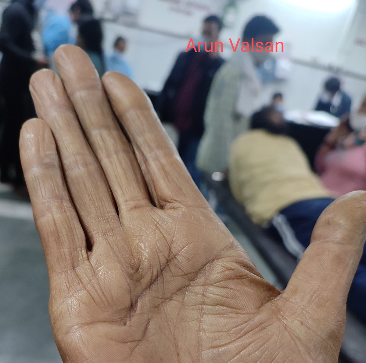 🔴Hepatology Bedside Pearls

✅Dupuytren's Contracture
("Hand of Papal Benediction) 
🔶Guillaume Dupuyt...