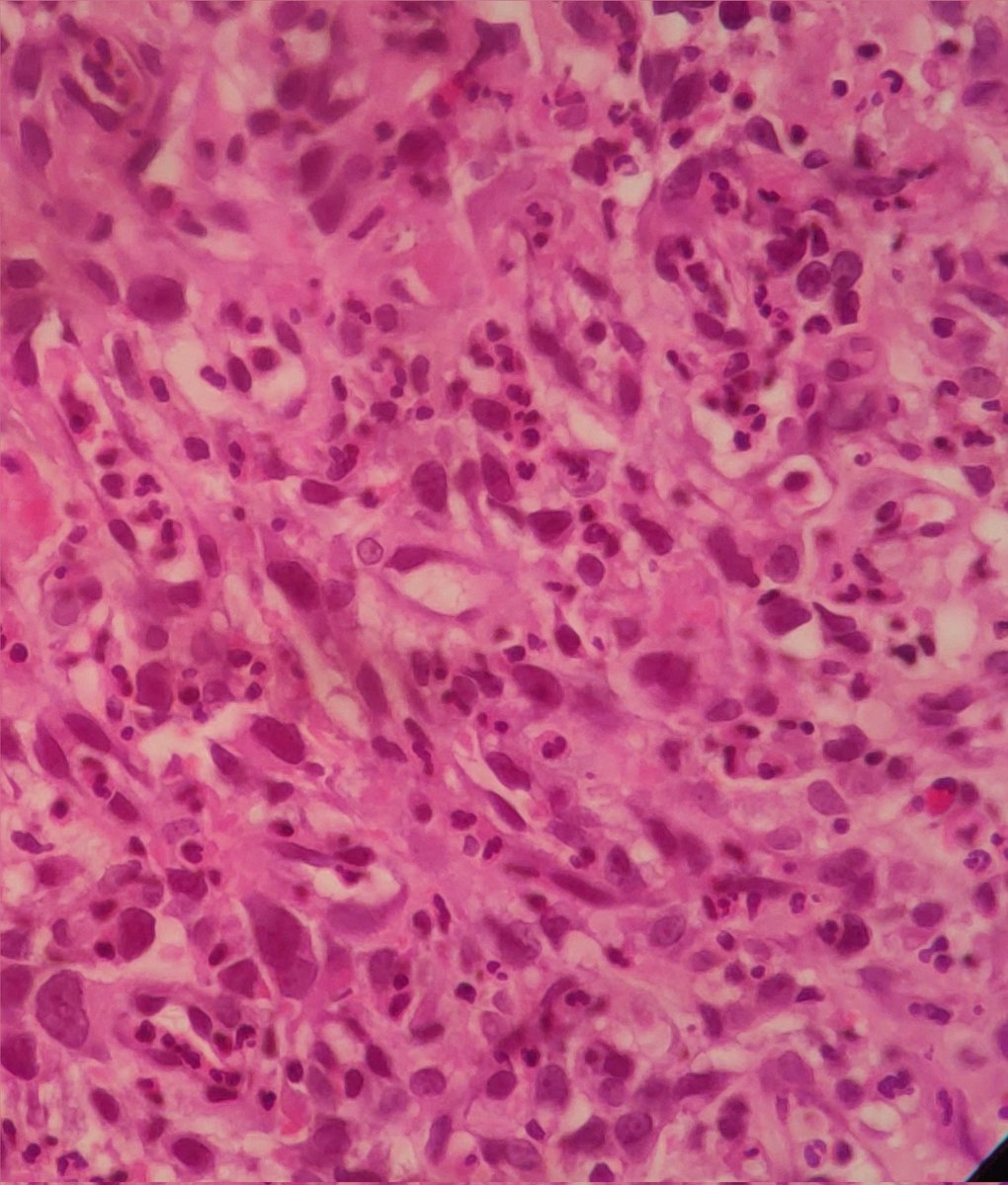 joemdoc's tweet image. Hey #twitterPath, 85/F. Gastric Fundal Mass
What's the diagnosis here?