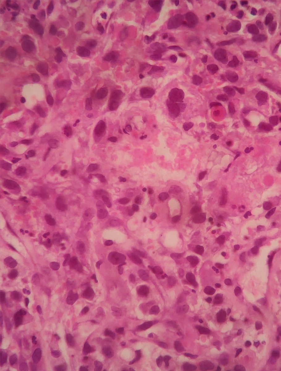 joemdoc's tweet image. Hey #twitterPath, 85/F. Gastric Fundal Mass
What's the diagnosis here?