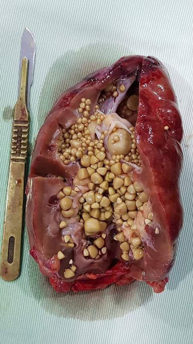 SURGICAL_Tm's tweet photo. You could be 20yrs old  but your organs could be older (50+yrs) function wise,due to misuse and negligence.  
Take care of your your body it will cost you later if you dont... 
Kidney stones... https://t.co/ZqLgOtALv7