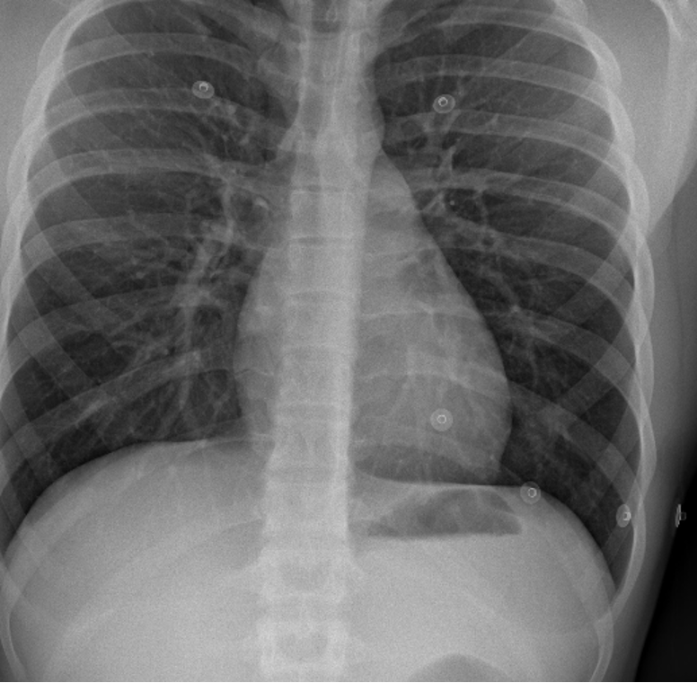 🔴 ¡Hoy caso clínico! 
Varón de 17 años. Acude por cuadro de dolor centrotorácico sin irradiación de tipo quemazón con empeoramiento en decúbito supino y sin variación con la respiración profunda.
Dos días antes se le administro 2ª dosis de vacuna BNT162b2 de ARNm 👇☢️