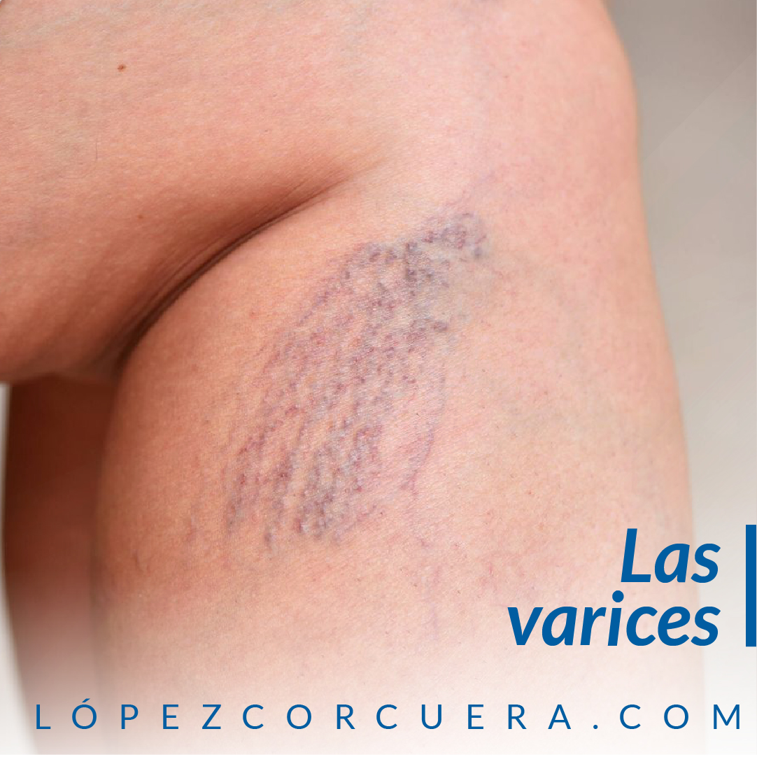 lopezcorcuera's tweet photo. Las varices no son solo un problema estético, son un problema de salud causado por una insuficiencia venosa. Contamos con tratamientos para su prevención cuando aparecen los primeros síntomas: hinchazón, edema, cambio de color en la piel, hormigueo o picor. https://t.co/WiEiuPmqF7