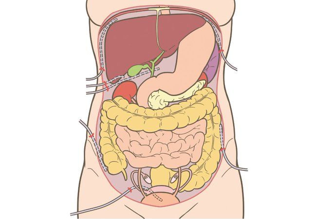 看護roo 公式 かんごるー 消化器系術後のドレーン留置部位のイラストがほしい W はい 右横隔膜下腔 左横隔膜下腔 ウィンスロー孔 モリソン窩 右傍結腸溝 左傍結腸溝 ダグラス窩 フリー素材 看護師 イラスト集 消化 看護roo 公式 かんごるー 消化器系術後のドレーン留置部位のイラストがほしい W はい 右横隔膜下腔 左横隔膜下腔 ウィンスロー孔 モリソン窩 右傍結腸溝 左傍結腸溝 ダグラス窩 フリー素材 看護師 イラスト集 消化