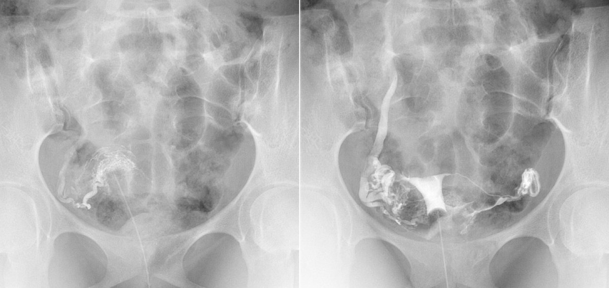 RadiologyCored's tweet photo. Venous intravasation occurs when contrast enters the draining pelvic veins through the myometrium.  The radiologist noticed this phenomenon and subsequently pulled back the catheter into the lower uterine segment during the hysterosalpingogram.  #radras #radiology https://t.co/8Gj34Q84Xu