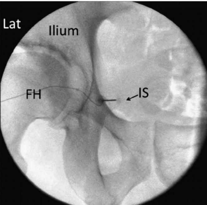 Innovando en el tratamiento del dolor pélvico crónico. Implante exitoso de electrodos de neuroestimulación <a href="/bostonsci/">Boston Scientific</a> en nervios pudendos, bajo control ecográfico y radiológico. Mejoría del dolor en menos de 24 horas de un 90%
#granequipo #siempreinnovando #dolorcrónico