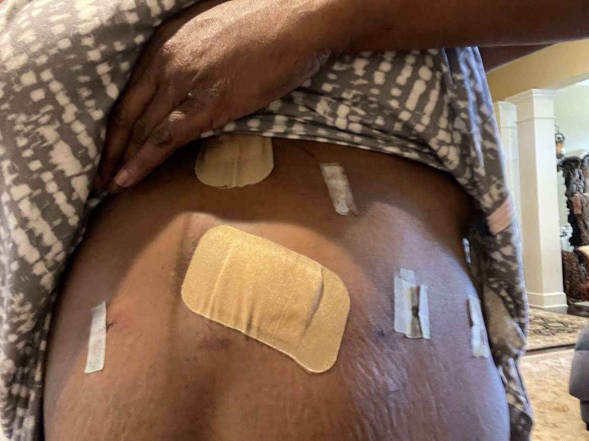 TomekaNapper's tweet photo. You can't see my scars, unless I show em. Most are invisible anyway. Each incision was a step towards relief. Healing underway. To God Be The Glory!!! #achalasia #achalasiaawareness #HelpTomekaEatAgain https://t.co/tBxvilySf3