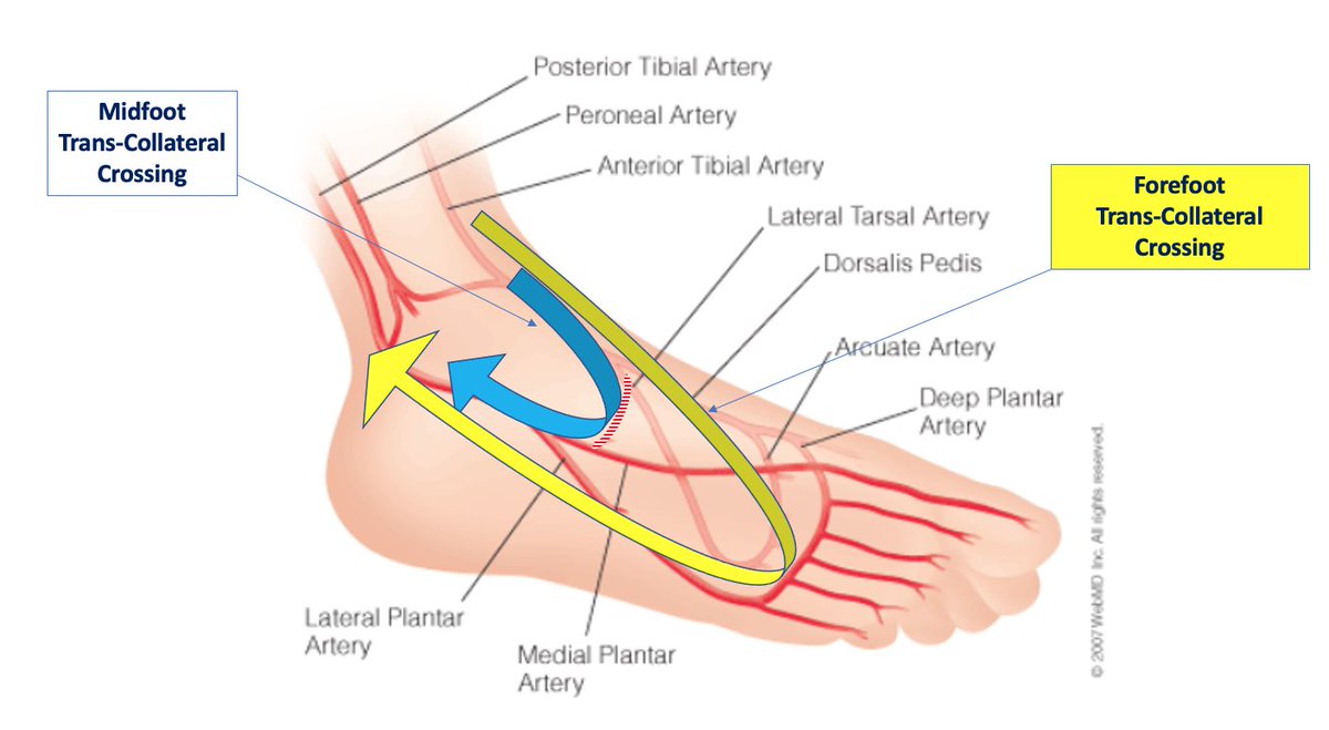 HadyLichaaMD's tweet photo. #PERIPHERAL series Ep. 2: #MidFoot vs #Forefoot #Transcollateral #wire #crossing
https://t.co/JHSmn7Mgbn
@SCAI @DrAmirKaki @EricSecemskyMD @herbaronowMD @mirvatalasnag @SanChris999 @Pooh_Velagapudi @RajTayalMD @kerrigjl @dandu_n @SripalBangalore @LorenzoPatrone3 @YsaAugust https://t.co/6Cor5cWJUt