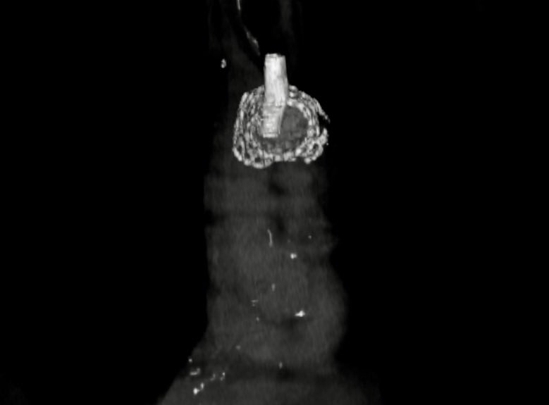 lbncbma's tweet photo. #endovascularsurgery #PTA #criticallimbIschemia #thinkaorta  #medtwitter
#aneurysm #practicemakesperfect #vasculartraining #hybridroom #teamvascular #revascularization #amputationprevention  #surgicalbypass #varizes #peripheralarterialdisease #PADdiagnosis https://t.co/Q5lEigKXI9