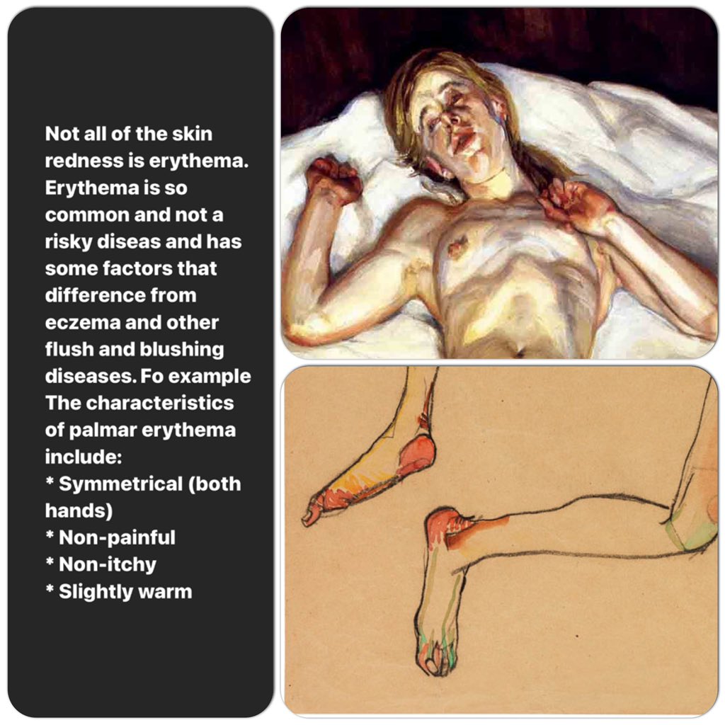 farsamartist's tweet photo. Part 2
Erythema and blushing effects in figures painted by Lucian freud , Egon Schiele and other great masters.
Author : Farsam Sangini
#anatomyforartists #anatomypractice #anatomytips https://t.co/kVMgxqKZ5w