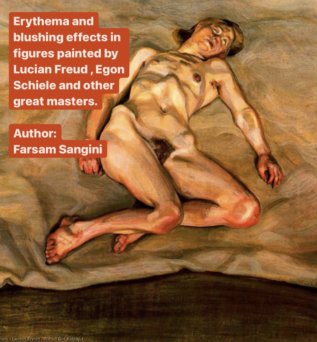 farsamartist's tweet photo. Part 1
Erythema and blushing effects in figures painted by Lucian freud , Egon Schiele and other great masters.
Author : Farsam Sangini
#anatomyforartists #anatomypractice #anatomytips https://t.co/2tVRbh63dy