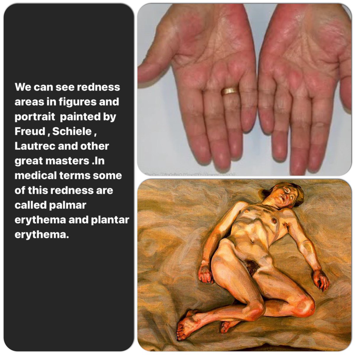 farsamartist's tweet photo. Part 1
Erythema and blushing effects in figures painted by Lucian freud , Egon Schiele and other great masters.
Author : Farsam Sangini
#anatomyforartists #anatomypractice #anatomytips https://t.co/2tVRbh63dy