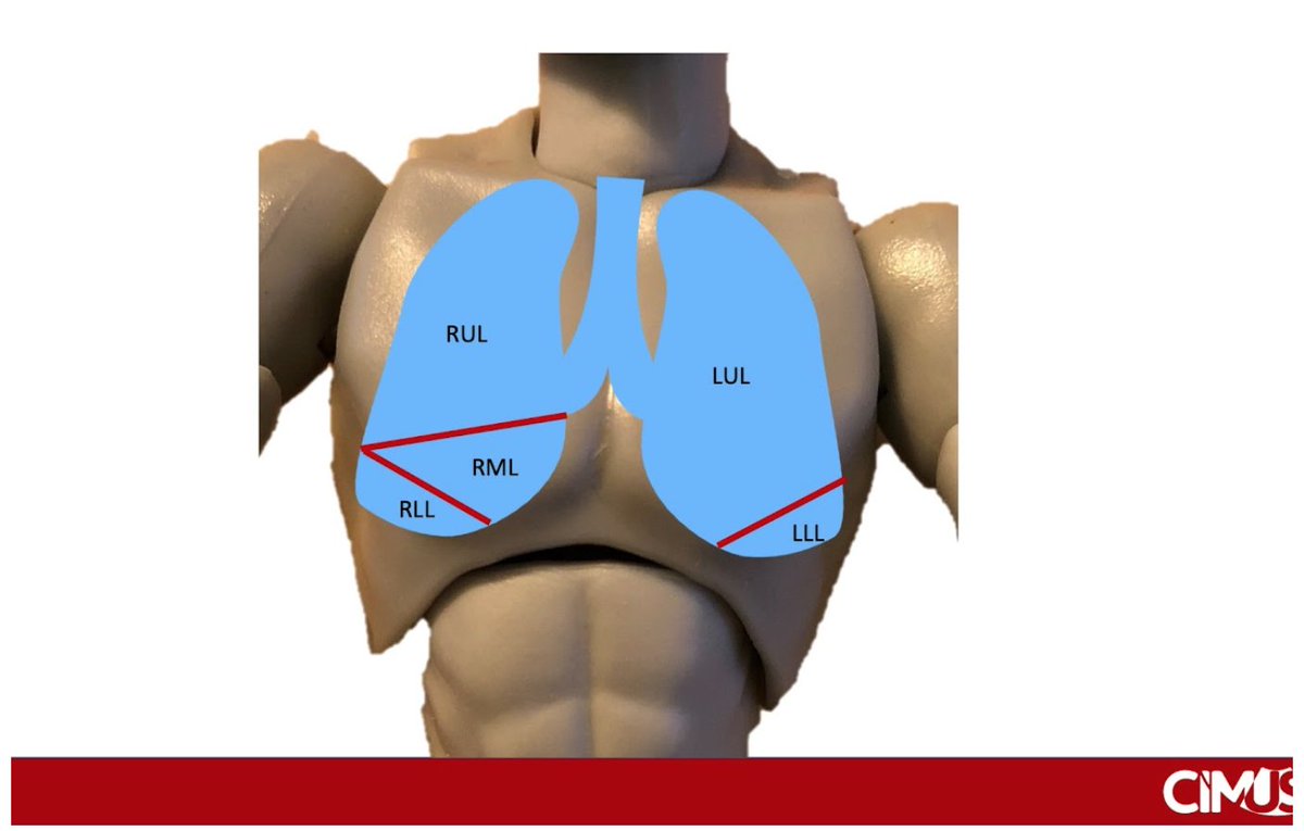 IM_POCUS's tweet photo. Ever wondered which lobe/segment of the lung you're scanning during #IMPOCUS (or during PE for that matter)?  Check out our new surface anatomy page:  #FOAMed https://t.co/dqhArxREpn https://t.co/mXdIRFIMyH