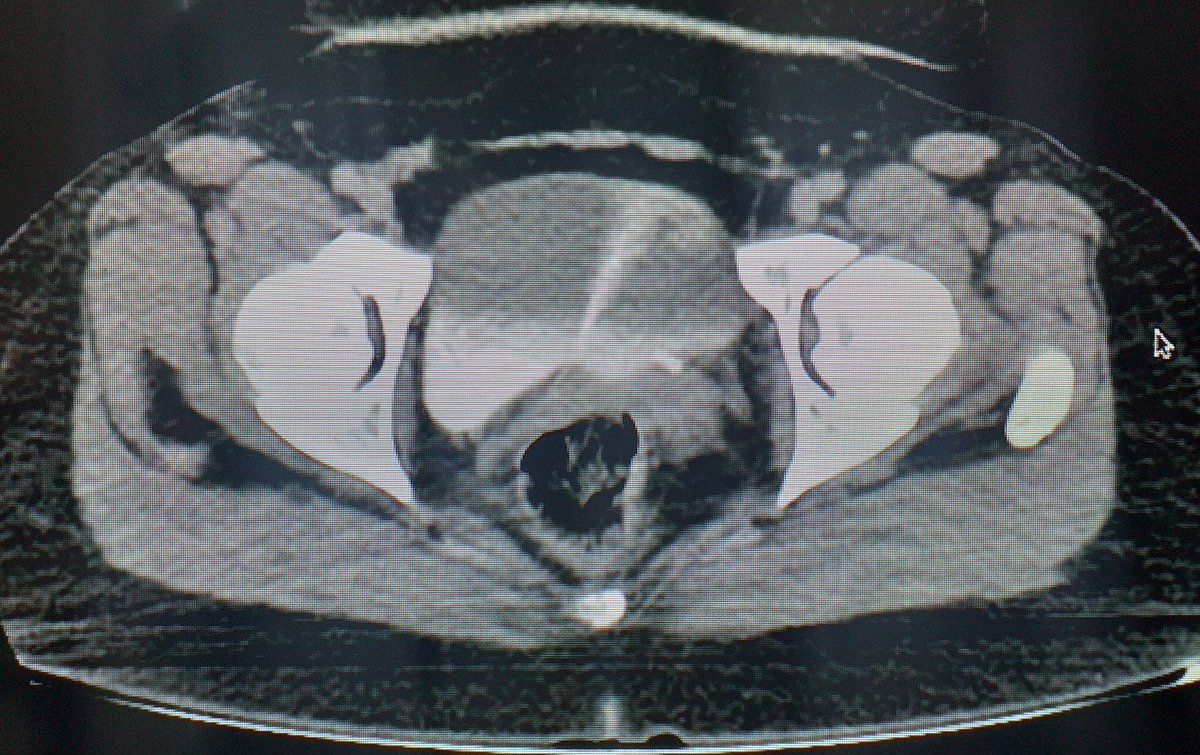 Emanuel Martinez Pagano, MD.🇦🇷 (@emamarpa) on Twitter photo Ureteral JET in CT Scan! ✅⚠️💦
Like a Volcano! 🌋
Or like a Shooting Star 🌠
Maybe like a whale on the sea surface! 🐳
IMAGINATION ... 💭💭💭
<a href="/ResidentesCAU/">Oficina Residentes CAU</a> <a href="/ESRUrology/">European Society of Residents in Urology</a> <a href="/ResidentesAEU/">RAEU - Spanish Urology Residents Working Group</a> Ureteral JET in CT Scan! ✅⚠️💦
Like a Volcano! 🌋
Or like a Shooting Star 🌠
Maybe like a whale on the sea surface! 🐳
IMAGINATION ... 💭💭💭
<a href="/ResidentesCAU/">Oficina Residentes CAU</a> <a href="/ESRUrology/">European Society of Residents in Urology</a> <a href="/ResidentesAEU/">RAEU - Spanish Urology Residents Working Group</a>