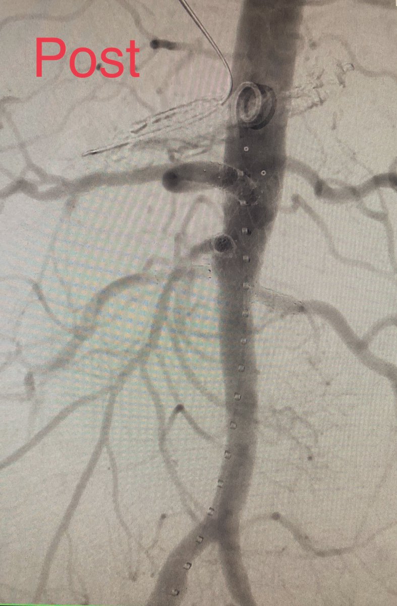 Chong Li MD, RPVI (@chongli04us) on Twitter photo Antegrade in situ laser fenestration through a back table modified limb for a visceral AAA ⚡️⚡️⚡️unconventional solution for an unconventional disease! <a href="/TomMaldonadoMD/">Thomas Maldonado</a> <a href="/nyu_vascsurgery/">NYUGSOM Vascular Surgery</a> #vascular #vascularsurgery #aorta #MedTwitter #evar #endovascular Antegrade in situ laser fenestration through a back table modified limb for a visceral AAA ⚡️⚡️⚡️unconventional solution for an unconventional disease! <a href="/TomMaldonadoMD/">Thomas Maldonado</a> <a href="/nyu_vascsurgery/">NYUGSOM Vascular Surgery</a> #vascular #vascularsurgery #aorta #MedTwitter #evar #endovascular