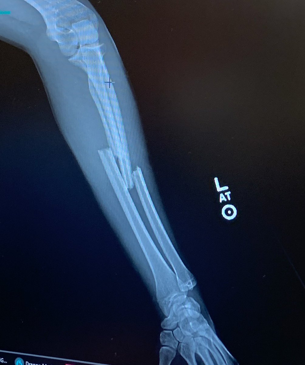 Very bitter return to play only 90 seconds into my first scrimmage. Prayers go up for everyone this season to remain injury free because I would never wish this on anyone