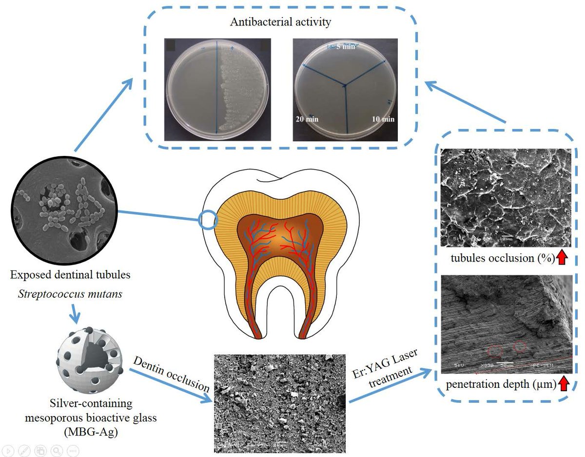 Pharmaceut_MDPI's tweet image. The Latest published Article by Prof. Jung-Chang Kung et al.: The #Antibacterial and #Remineralization Effect of Silver-Containing Mesoporous Bioactive Glass Sealing and Er-YAG Laser on #DentinalTubules.

#DentinHypersensitivity 

📄Read Via:
mdpi.com/1424-8247/14/1…
