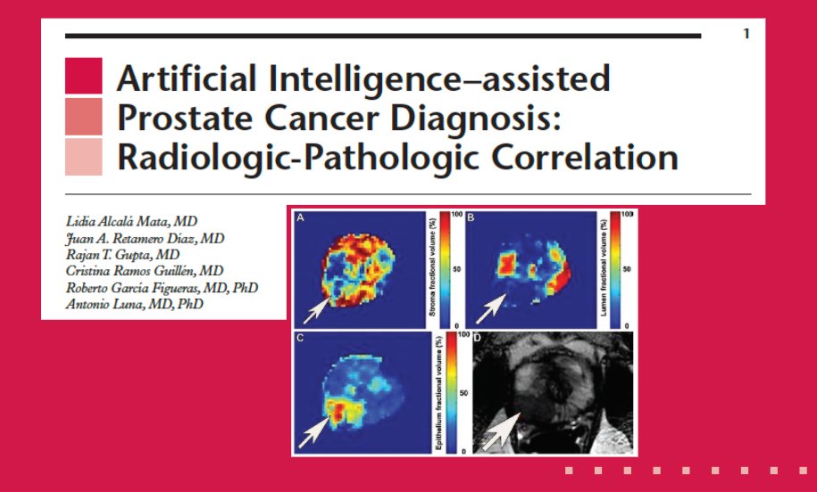 aamalayeri's tweet photo. This monograph article by @lidiaalcalmata et al. discusses the current role of AI in PCa diagnosis pathways, including mpMRI, MRI-TBx, and pathology, as well as the potential for AI to improve the management of PCa.
https://t.co/FlgPUavTg1
#RGphx
@RadG_Editor
@cookyscan1 https://t.co/VvkLdqJckS