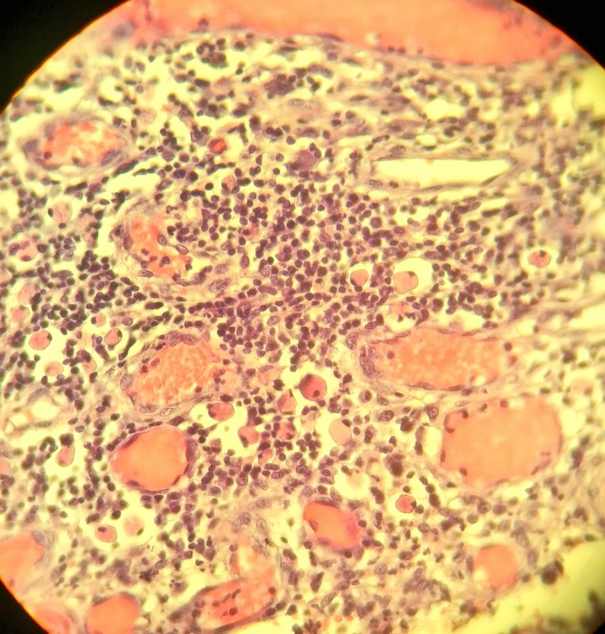 nadpath's tweet photo. Hey #PathTwitter , what do you think about these tiny PAS positive creatures in colon biopsy? #GIpath https://t.co/sCtWWWD7uX
