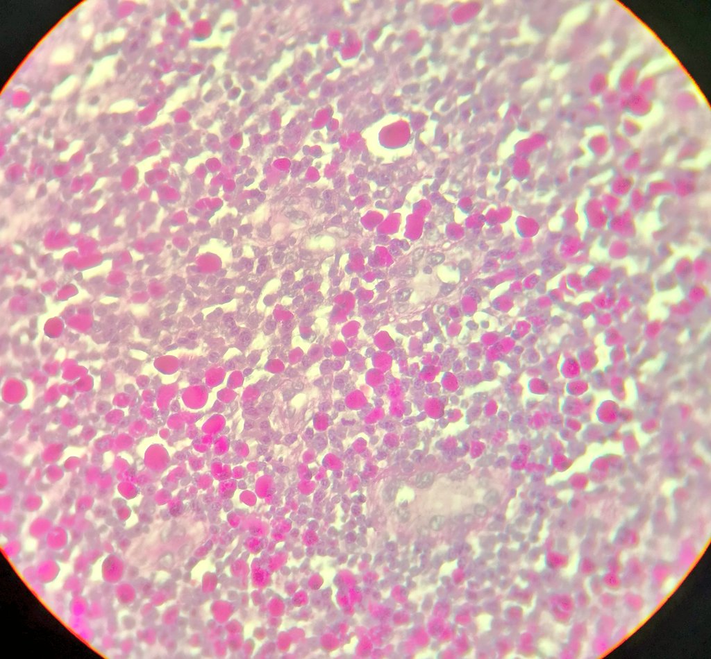 nadpath's tweet photo. Hey #PathTwitter , what do you think about these tiny PAS positive creatures in colon biopsy? #GIpath https://t.co/sCtWWWD7uX