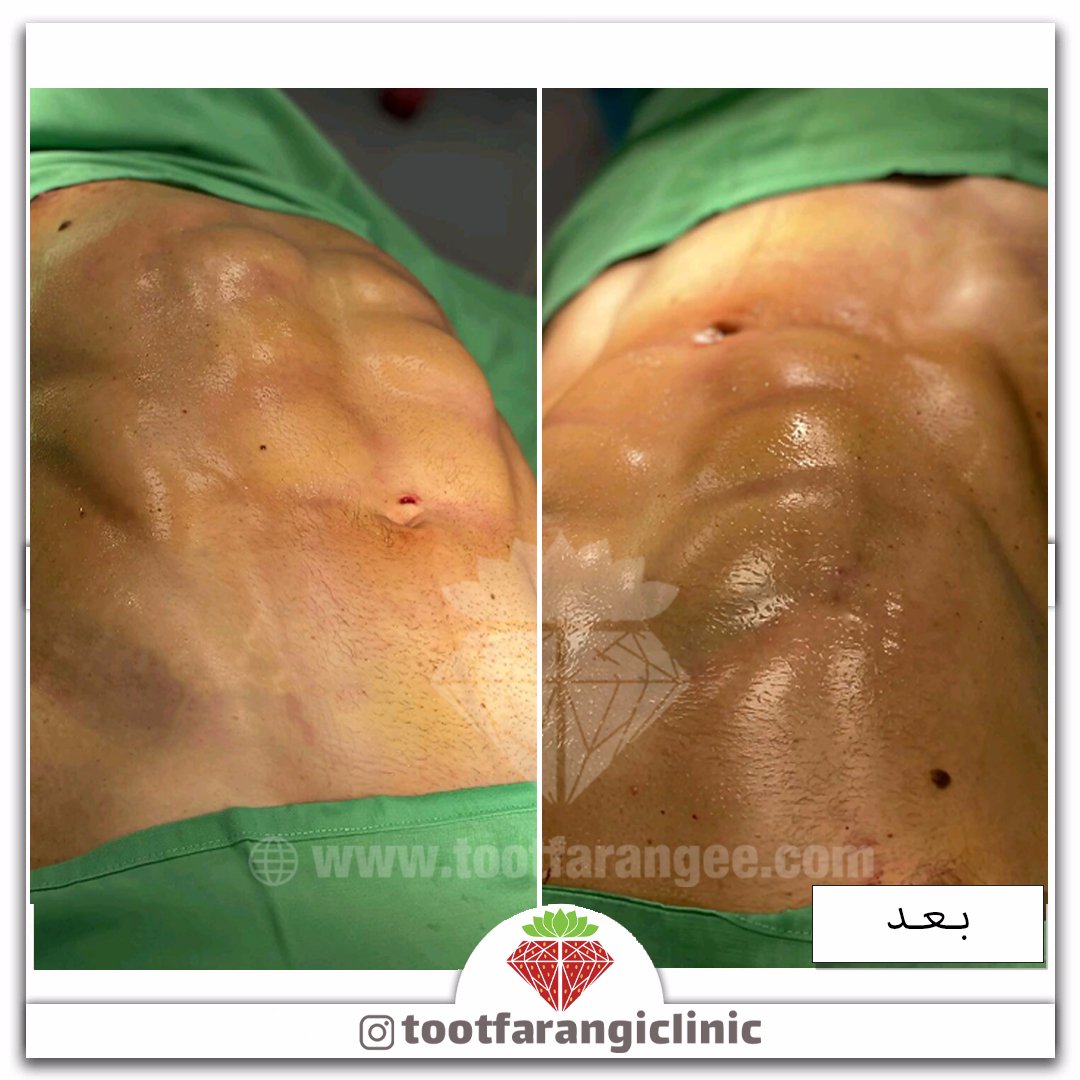 Tootclinic's tweet photo. #ویزر #پیکرتراشی #سیکسپک #سیکس_پک #لاغری #زیبایی #ابدومینوپلاستی #ماموپلاستی https://t.co/djLw6qFZqK