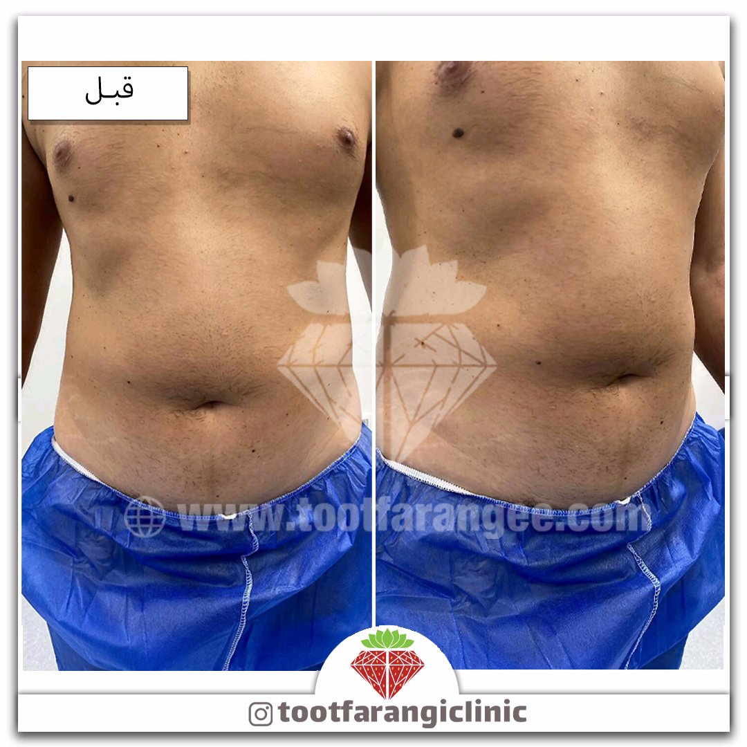 Tootclinic's tweet photo. #ویزر #پیکرتراشی #سیکسپک #سیکس_پک #لاغری #زیبایی #ابدومینوپلاستی #ماموپلاستی https://t.co/djLw6qFZqK