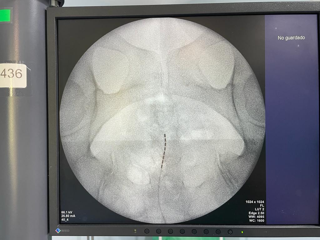 anestesiactg's tweet photo. 🔴Coccigodinia refractaria

⚡#Neuromodulación mediante técnica de abordaje retrogrado y colocación de electrodo octopolar de @bostonsci

#ChronicPain @Sedolor @Area2Cartagena @EspanaIns @JNeuromod @IntlNeuromod @SMurcianadolor @Murciasalud
@commurcia https://t.co/PnW8wRptG9