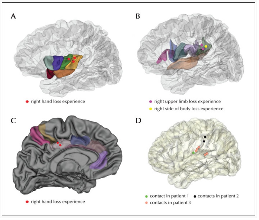 SBeniczky's tweet photo. Limb loss experience is a type of body illusion characterized by the sensation of a missing limb. It can be triggered by electrical stimulation of posterior insula, parietal operculum, and posterior cingulate cortex.
https://t.co/iYOWSiWUDG
#epilepsy @EpiDisorders @IlaeWeb @Fabio https://t.co/OQj3jqiNwn
