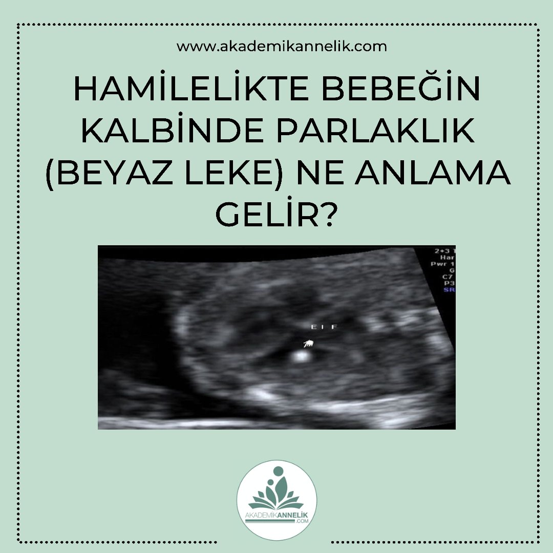 BEBEKTE KALPTE PARLAKLIK (HİPEREKOJENİK KARDİYAK) NEDİR?
 Ayrıntılı bilgi: akademikannelik.com/Hamilelik-Deta…
#hamilelik #gebelik #pregnancyhealth #pregnant #downsyndrome