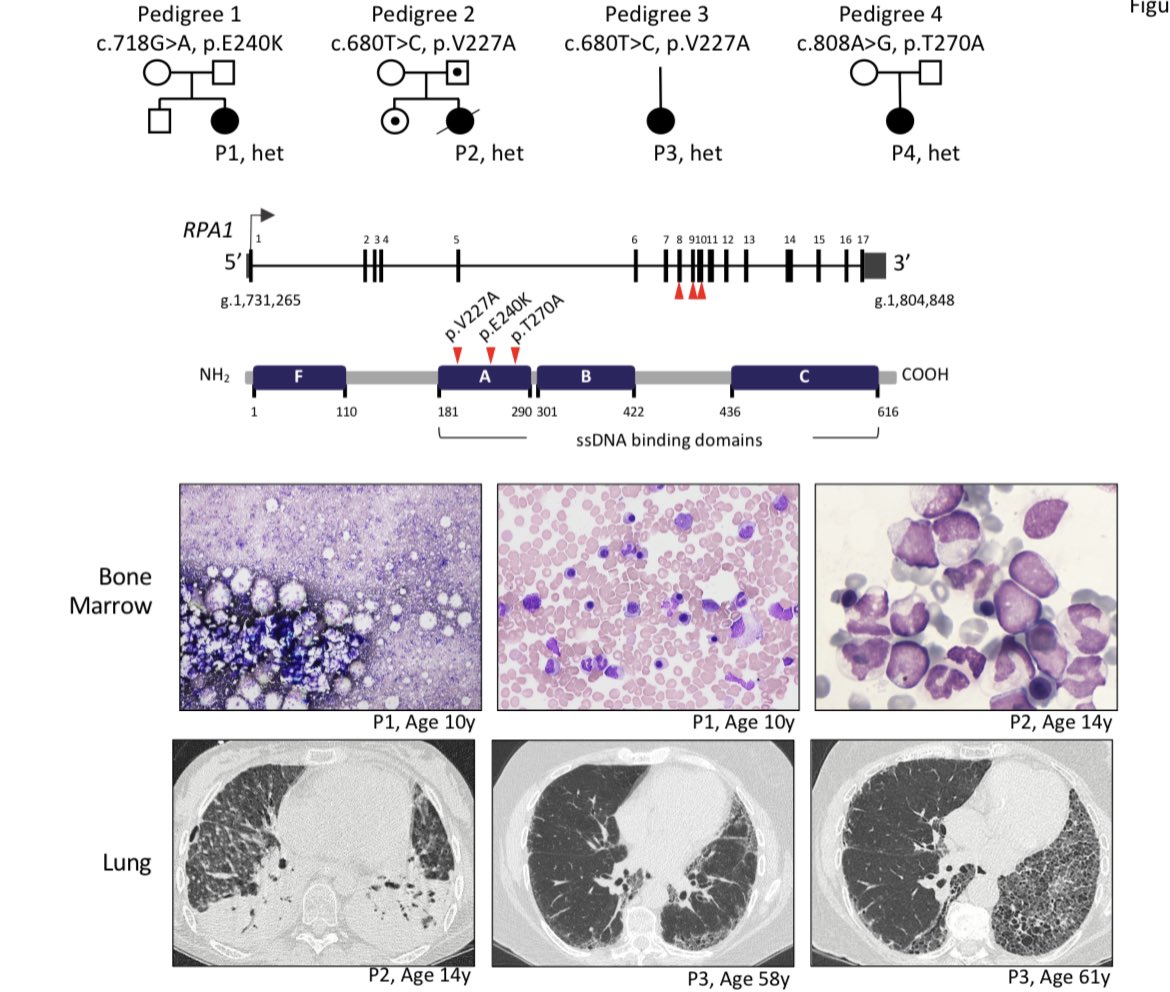 emmamgroarke's tweet photo. Just published in @BloodJournal - newly discovered gain of function mutations in #RPA1 cause #telomere biology disorders. Exciting that new genes continue to be discovered! Congrats @marrowgenes @sushreesahoo90 https://t.co/6iHZBOAyJX https://t.co/oRMyFeXjTW