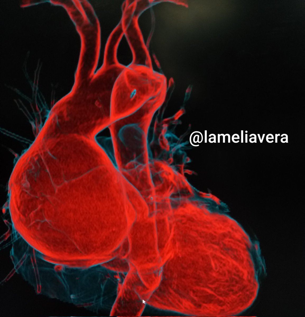 lameliav's tweet photo. Aorta Torácica #angiotac #tomography #angio https://t.co/CMEPWz16Cr