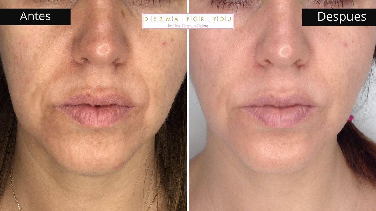 Dermaforyou's tweet photo. Tratamiento para brillo y restaurar armonia facial conseguido en 3 sesiones.
-1 ses: 2 viales de #acidohialuronico #voluma en pómulo y surco nasogeniano.
-2 sesión: 1 vial de #volift en surco nasogeniano y 1 vial de voluma en mejilla.
-3 sesión: Peeling de @zoskinhealth https://t.co/FQ8clkLEs3