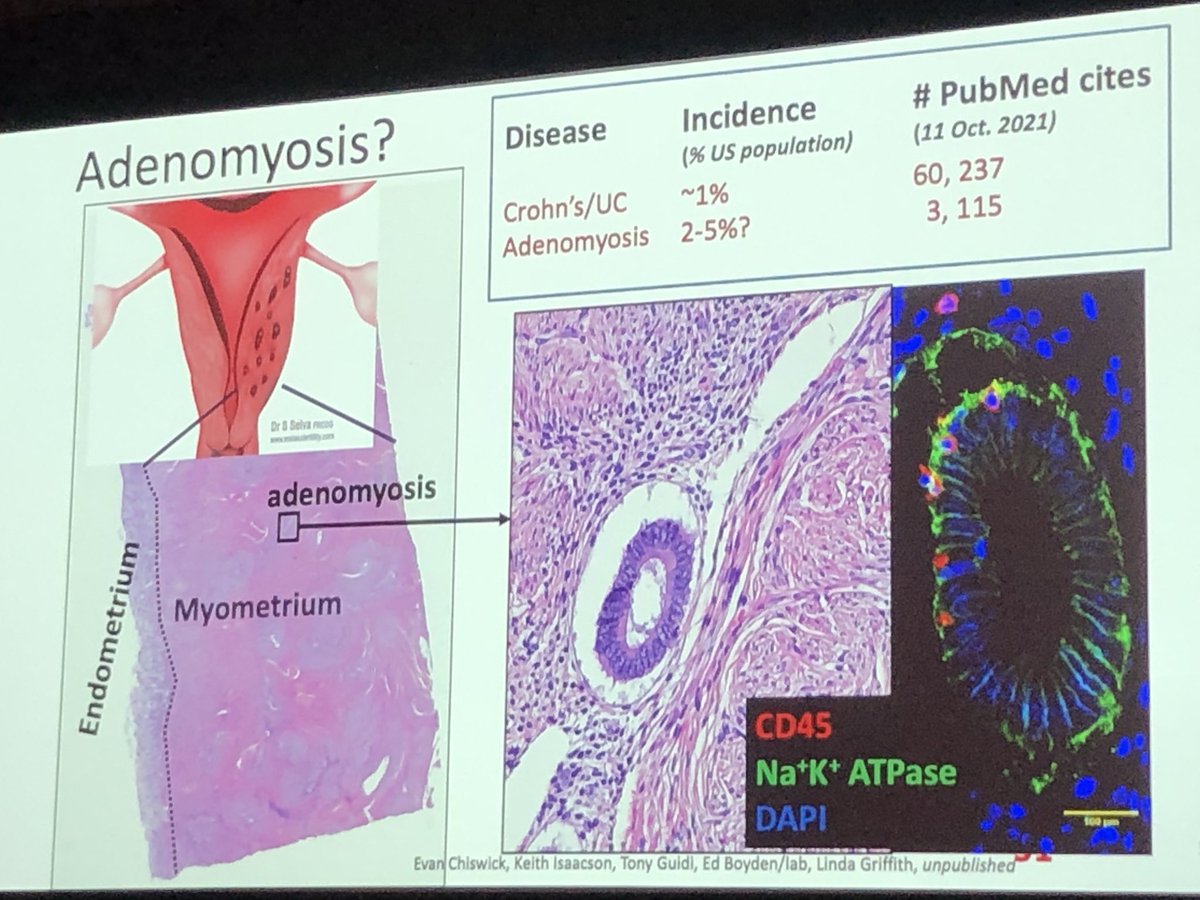 FANTASTIC and inspiring talk by Dr. Linda Griffith, engr prof <a href="/MIT/">Massachusetts Institute of Technology (MIT)</a> on her work on #endometriosis #adenomyosis and organs on a chip. Engineering + #MIGS collab FTW. Significant funding and #pubmed disparities on adenomyosis. Fund us! <a href="/AAGL/">AAGL</a> <a href="/AAGLJMIG/">JMIG</a> #AAGL21 <a href="/NIH/">NIH</a>