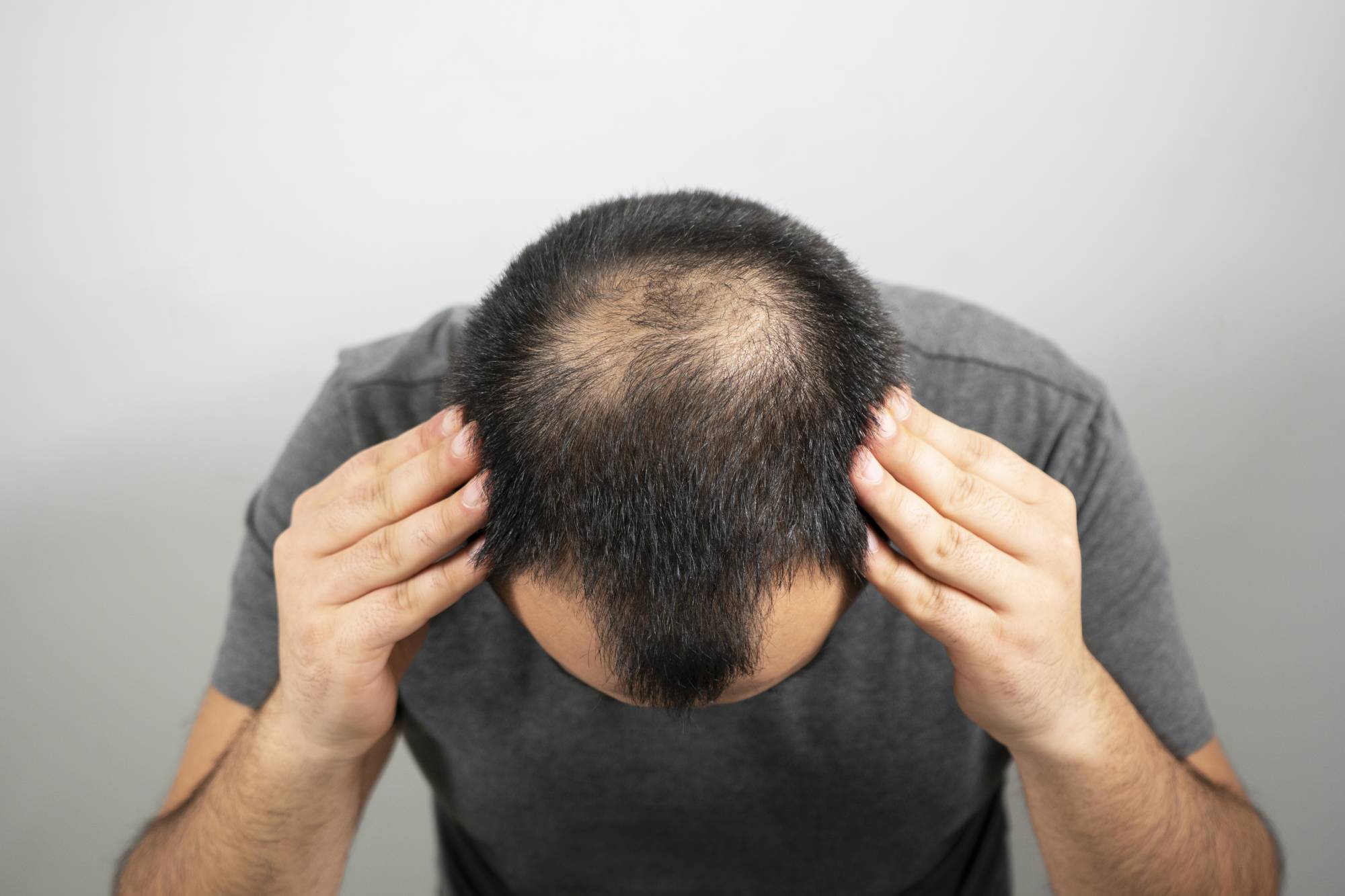 Hair Loss Treatment  PRP Hair Growth Programme