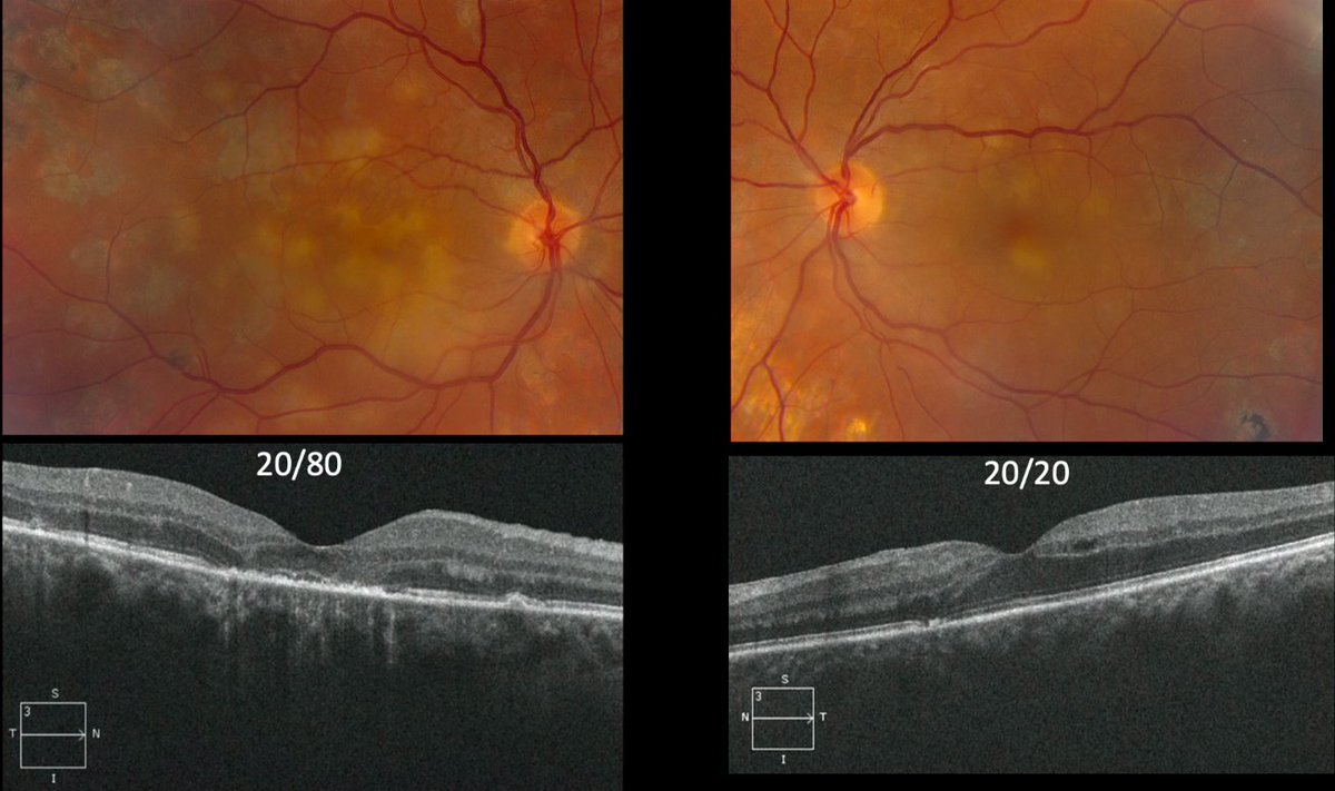 DrewCareyMD's tweet photo. Dr. Michael Jumper from West Coast Retina presents an extremely rare case of Relentless #Placoid Chorioretinopathy from systemic #sarcoid with multiphasic lesions that block early and stain late #retina #macula #AAO2021 @aao_ophth @asrsdocs https://t.co/wkMN8LvVAi