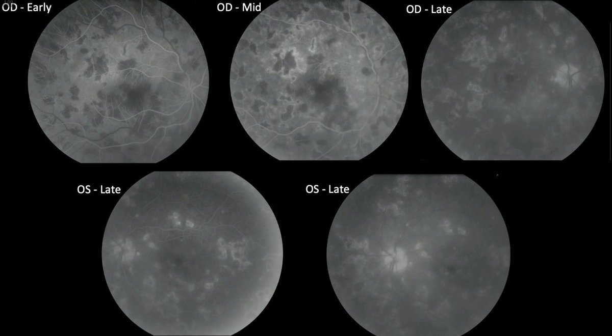 DrewCareyMD's tweet photo. Dr. Michael Jumper from West Coast Retina presents an extremely rare case of Relentless #Placoid Chorioretinopathy from systemic #sarcoid with multiphasic lesions that block early and stain late #retina #macula #AAO2021 @aao_ophth @asrsdocs https://t.co/wkMN8LvVAi