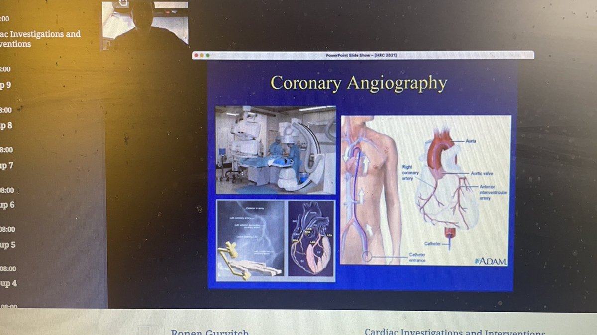 Dr Ronen Gurvitch <a href="/TheRMH/">The Royal Melbourne Hospital</a> talking on #cardiacinvestogations and #interventions at Day 2 #CRtraining2021ACHH #cardiacrehab #training #cardiologist <a href="/ACRA_ACRA/">ACRA</a> <a href="/worldheartfed/">World Heart Federation</a> #onlinetraining #australia  #somanyquestions #greatexplanations