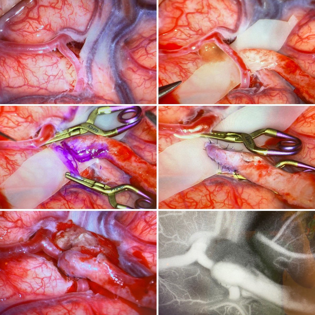 SkullBaseMD's tweet photo. #moyamoyamonday
Revascularization. One hemisphere at a time.
#mondaymotivation #moyamoya #stamca #bypass #flow #glow #feelinggrateful #livebrilliantly
@RUNeurosurgery @CBMCNJ @RWJBarnabas @Rutgers_NJMS @cvsection @ASCsurgical @moyamoyafdn @HouleMoyamoya https://t.co/69ZSHFL6FQ
