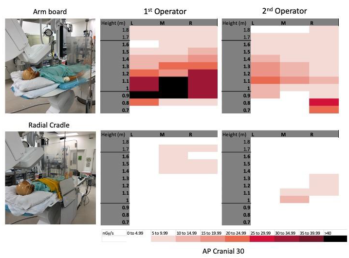 NBlatcher's tweet photo. Impressive 1st and 2nd operator rad protection confirmed by phantom dosimetry study presented @TCT2021. Simply achieved by ditching obstructing arm boards, optimally reconfiguring cath lab lead protection with the help of #radialcradle. Discover how to protect you and your team. https://t.co/JiRVVOkywG