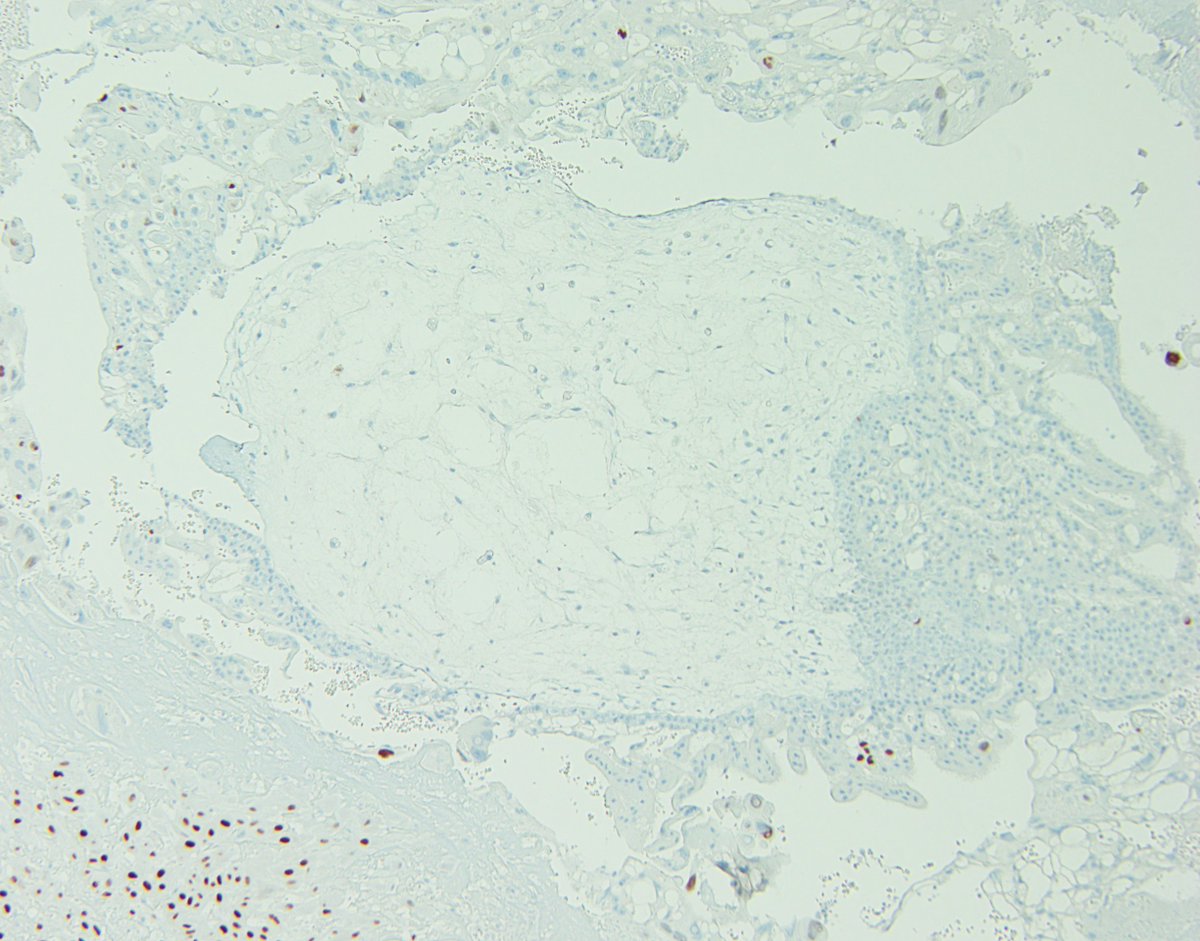 Esther Adler, MD (@drestheradler) on Twitter photo EMC from a patient with persistent vaginal bleeding and elevated B-HCG s/p EMC x 2 months prior. IHC is p57. What's the diagnosis and why does p57 confirm it? #GYNpath #pathology #MedEd <a href="/NYUGSOMpathres/">NYUGSOM Pathology Residency</a> EMC from a patient with persistent vaginal bleeding and elevated B-HCG s/p EMC x 2 months prior. IHC is p57. What's the diagnosis and why does p57 confirm it? #GYNpath #pathology #MedEd <a href="/NYUGSOMpathres/">NYUGSOM Pathology Residency</a>