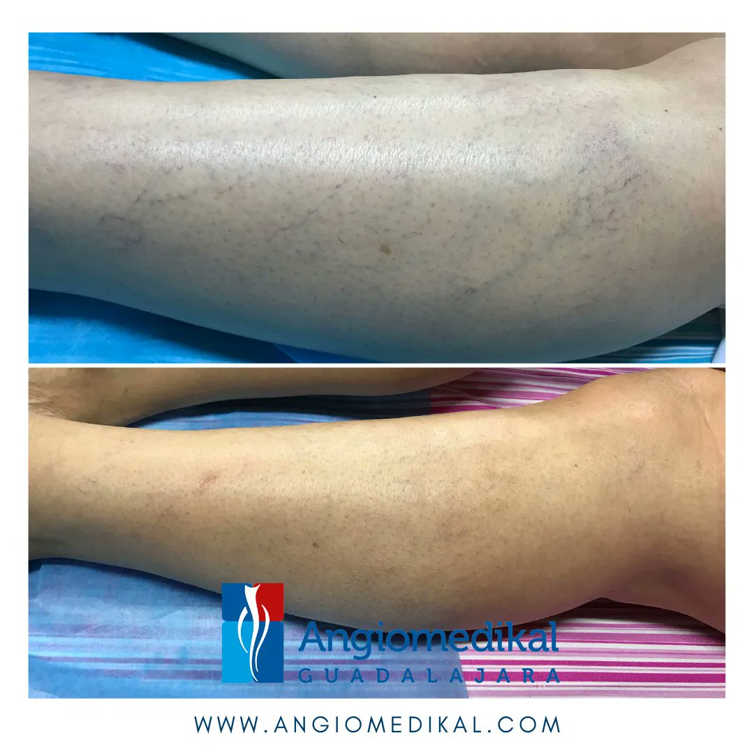 angioycvascgdl's tweet photo. ✅ Resultados de Escleroterapia ⭐️⭐️⭐️⭐️⭐️
✅Cuida tu circulación, #hazloenmanosdeexpertos
🌐 https://t.co/WerPZmf1Ec
#escleroterapia #varices #angiomedikal #insuficienciavenosa #angiotips #inyecciondevarices #esclerosisdevarices #clinicadevarices #angiologo #gdl https://t.co/LDrsocoJKJ